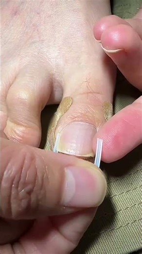 Say Goodbye to Ingrown Toenails with These Simple Stickers( # 2609 ) 1️⃣