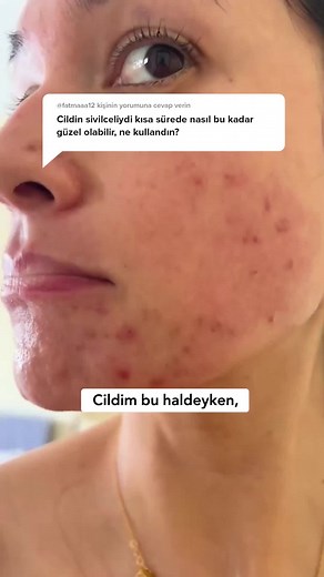 Cildinizdeki akneleri etkili bir şekilde hedef alarak, her kullanımdan sonra daha temiz ve taze bir görünüm elde edin.