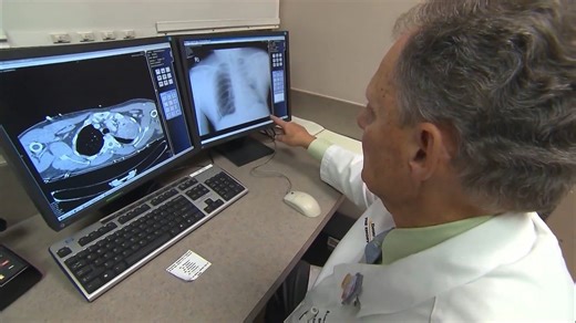 How AI is detecting lung cancer sooner