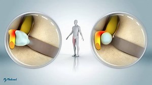 79K views · 1.1K reactions | Comment soigner une hernie discale ? | Biologie Université | Facebook