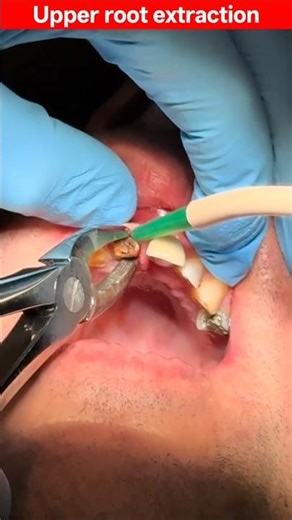 Upper root extraction simplified | root canal #extraction #implants #shorts #viral