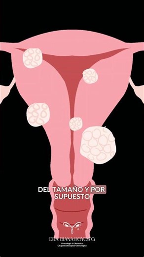 Miomas uterinos