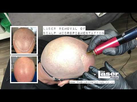 Remove That SMP (Scalp Micropigmentation)!!- Full Laser SMP Removal in Just 2 Sessions