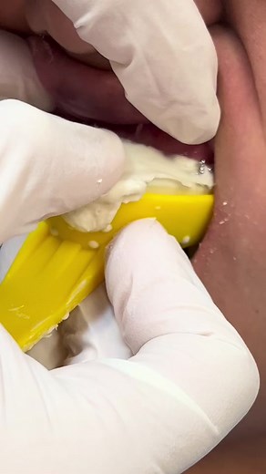 OH NO! This impression was a FAIL😭 #teeth #tooth #dentist