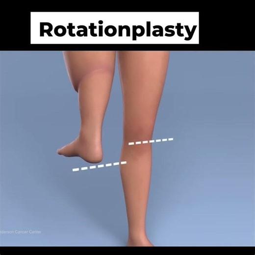 Rotationplasty The Most Shocking Surgery You’ve Never Seen! #medicalshorts