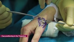 How I Do a Trapezio Metacarpal Arthroplasty for a Thumb CMC Arthritis