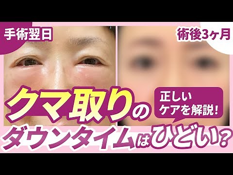【必見】クマ取りのダウンタイムはひどい？実際の症例と正しい術後ケアを解説！【裏ハムラ/脱脂】