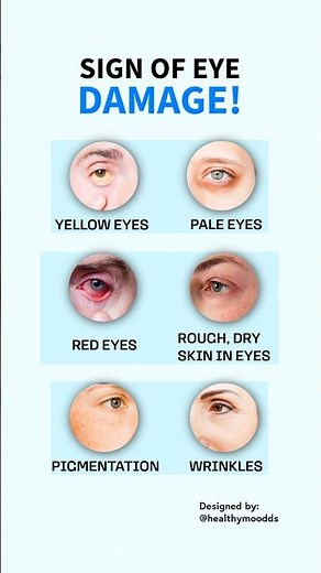 "Warning Signs Your Eyes Are in Trouble! 👁️🚨" #healthylife #eyeshealth