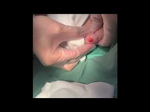 ⑧ 粉瘤くりぬき法 epidermal cyst atheroma cystic acne extraction 脂肪腫 lipoma クリニーク大阪心斎橋 大阪梅田院 名古屋栄院 福岡天神院 三宮院