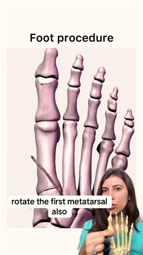 Lapiplasty Bunionectomy Explained