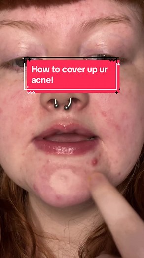 How to Cover Acne with Makeup: Tutorial for Beginners