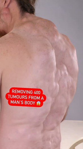 688K views · 7.3K reactions | Man undergoes a huge transformation after Dr Lee removes almost 400 tumours from his body! ‍⚕️ #DrPimplePopper | TLC UK | Facebook