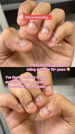 HOW TO STOP BITING YOUR NAILS!😱 #nails #nail #nailinspo #nailtutorial #nailbiting