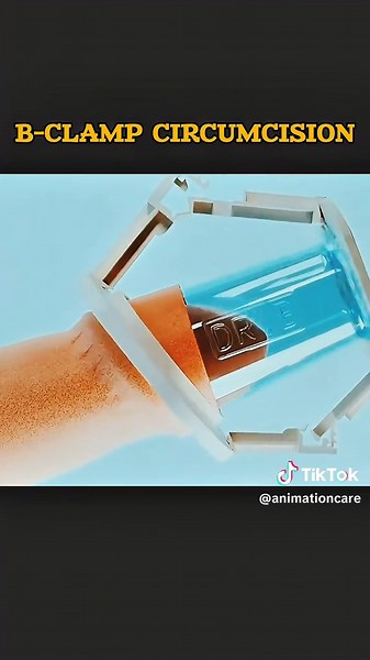 B-CLAMP Circumcision 3d Animations. Modern circumcision is a safe, quick, and minimally invasive procedure designed with advanced techniques for faster healing, less discomfort, and improved hygiene-offering patients confidence and peace of mind. Disclaimer: Educational video for public and young trainees. #bclamp #device #circumcission #medicalanimation #healtheducation