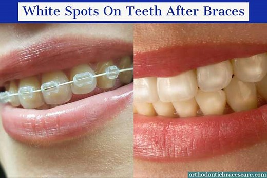 White Spots On Teeth After Braces: Causes, How To Fix - Orthodontic Braces Care
