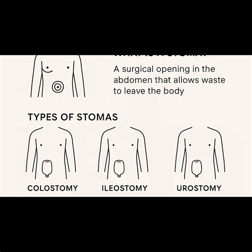 mr.colitis_stoma on TikTok