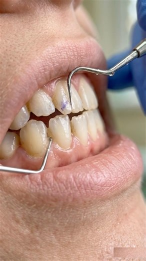 Deep Caries to Veneers: Anterior Tooth Transformation | #toothcraft #asmr #satisfying