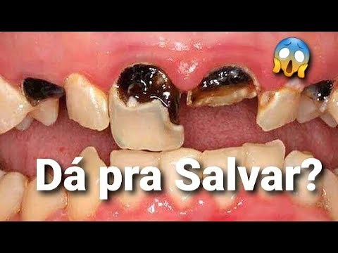 DENTES DA FRENTE CARIADOS TEM JEITO? Caso Clínico!
