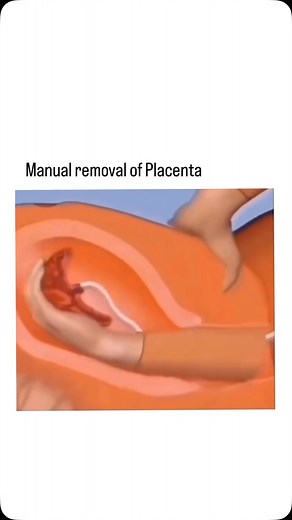 bran laboratory | After delivery, the placenta is typically expelled from the uterus naturally, but in some cases, it may need to be removed manually. This... | Instagram