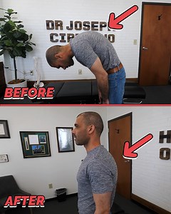 Breaking the Hunchback with Chiropractic Cracking! | Dr. Joseph Cipriano