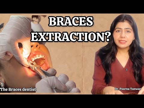 Do you really need tooth extraction for Braces | Dr Poorna Tanwar