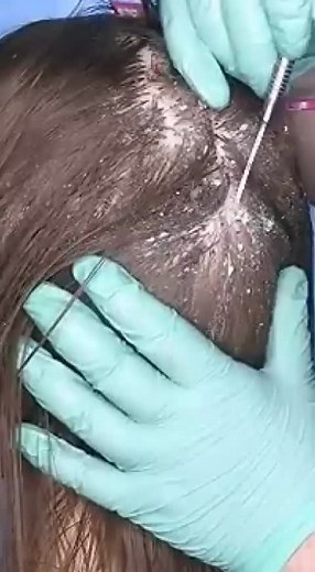 ASMR Dandruff Removal #asmr #dandruff #dandruffremovel #dandruffscratching #scalpscratching #scalp #relax #sleep #medical #dandruffsolution #tingles