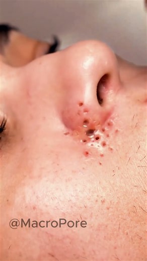 WATCH THE VACUUM DO ALL THE WORK 👀 #asmr #macroasmr #vacuumextraction