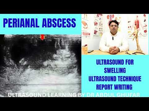 Perianal abscess | Soft tissue ultrasound | ultrasound abscess | ultrasound abscess vs cellulitis