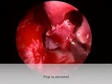 Endoscopic Septal Perforation Repair • Video • MEDtube.net