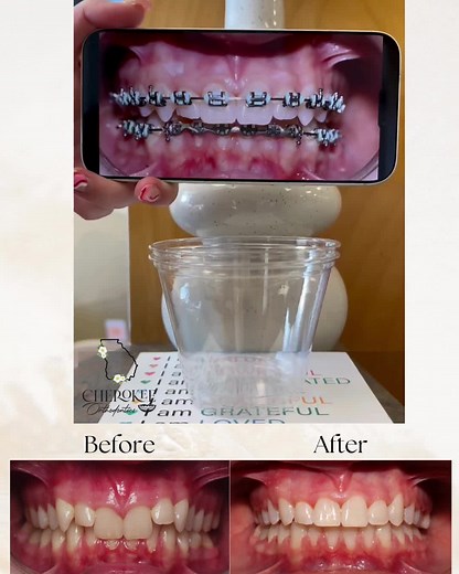 Thursday Transformation: Braces Before and After