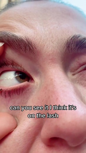Bugs and Insects in Eyes: Eyelashes, Dangers, and Removal