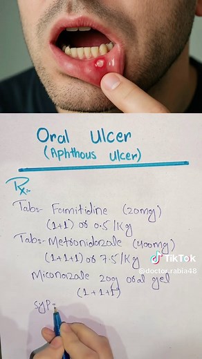 Effective Treatments for Oral Ulcers and Aphthous Ulcers
