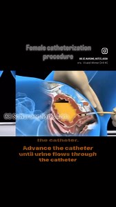 225K views · 1.6K reactions | Female Foley Catheter Insertion | Medical Talks | Facebook