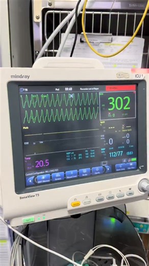 ECG on Instagram: "➡️ What's the RHYTHM? #ECG #Electrocardiography #Cardiology #HeartRhythms #CardiacCare #Arrhythmia #EPeeps #Electrophysiology #CardiacEP #HeartBeats #MedEd #FOAMed #CardioTwitter #ECGLearning #ClinicalCardiology #ECGInterpretation #ECGCase #ecgchallenge"