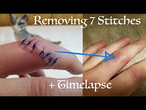Removing Stitches From Finger & Time-lapse Healing Process