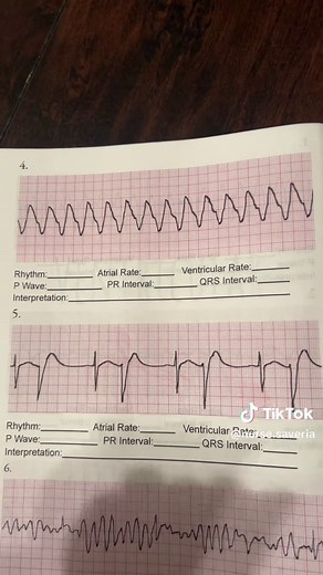 Interpreting Lethal Rhythm in Healthcare: A Guide