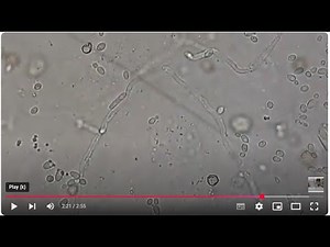 Candida and Aspergillus causative agent of Urinary Tract Infection (UTI)