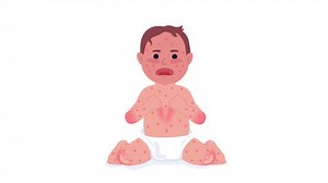 Crying Baby Measles 2d Character Animation Stock Footage Video (100% Royalty-free) 1109161781 | Shutterstock
