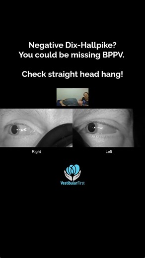 Straight head hanging test revealed right posterior canal BPPV treated with Bascule maneuver. #bppv