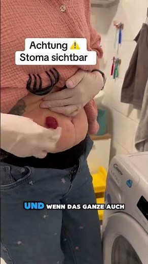 Stoma-Versorgungswechsel