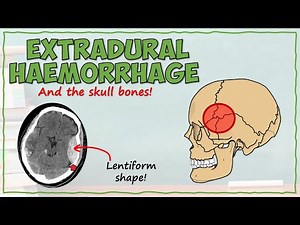 Anatomy of an Extradural Haemorrhage