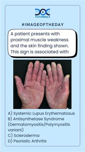 NEET PG Image of the Day | Identify the Proximal Muscle Weakness and the Associated Skin Finding!