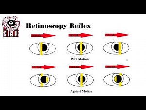 Retinoscopy reflex Source
