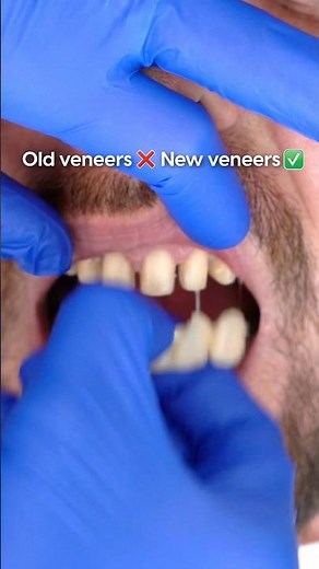 Dental Veneers Transformation | From Old Worn Veneers to a Natural New Smile