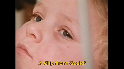 Scald