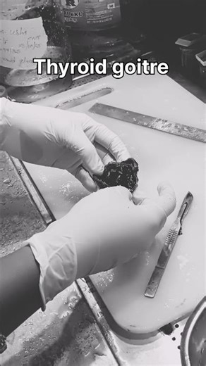 Colloid goitre in the right love of thyroid|#histopathology #thyroiddisorders #thyroidhealth #goitre