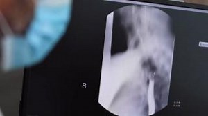 Did you know about the dangers of frequent heartburn? Dr. Shachner explains the risks and how we can help. #Heartburn #GERD | Broward Health