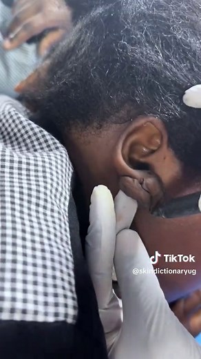 Ear keloid reconstruction focuses on removing or debulking keloids (overgrowth of scar tissue) on the ear, followed by reconstructive techniques to minimize distortion and recurrence.#keloid #keloidremoval #keloids #skindictionary