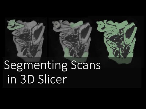 Segmenting Scans in 3D Slicer | Introduction to Digital Preparation Video 11