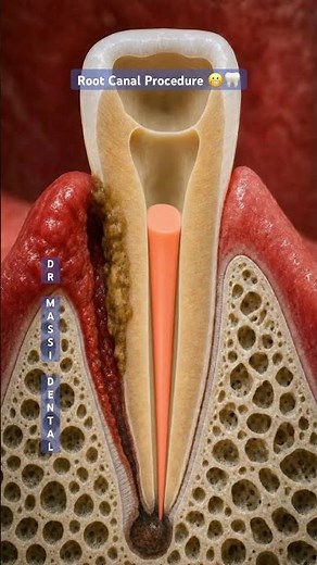 ROOT CANAL PROCEDURE 😬🦷